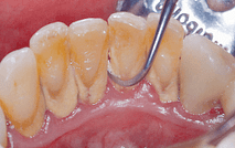 tartar removal