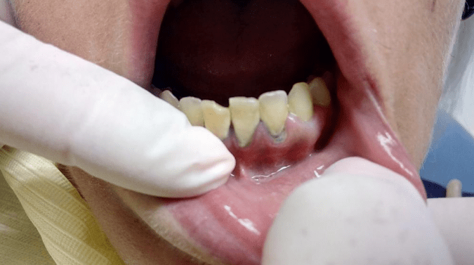 tooth decay
